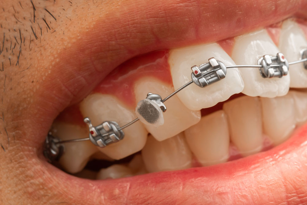 What to Do When Brackets Break or Wires Snap My LA Braces