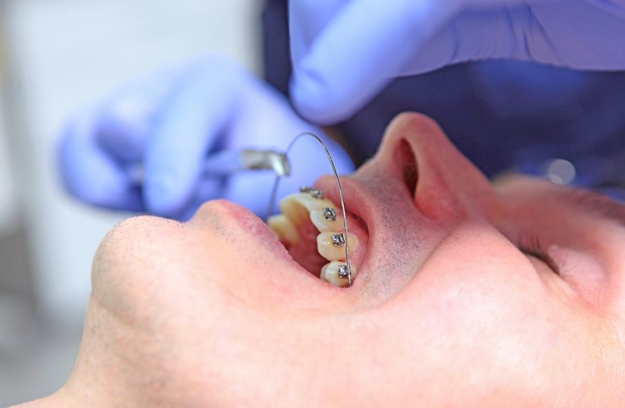 Getting braces is an exciting first step toward a straighter, healthier smile—but like any new experience...