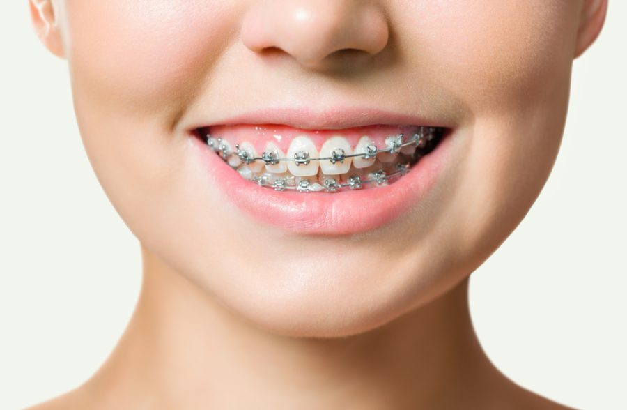 If you or your child needs orthodontic treatment, one of the first questions that comes up is simple...