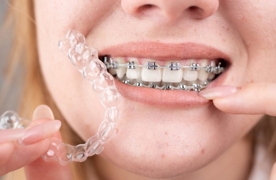 Clear aligner systems like Invisalign have become one of the most popular ways to straighten teeth for teens and adults...