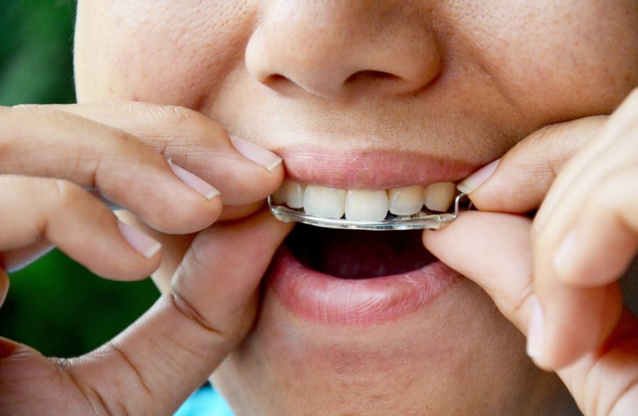 Finishing orthodontic treatment is an exciting moment. After months or years of wearing braces or Invisalign, you finally see the straight smile you worked so hard for....