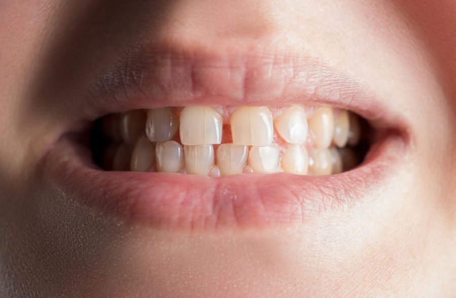 Can Braces Fix a Gap Between My Front Teeth? What to Realistically Expect