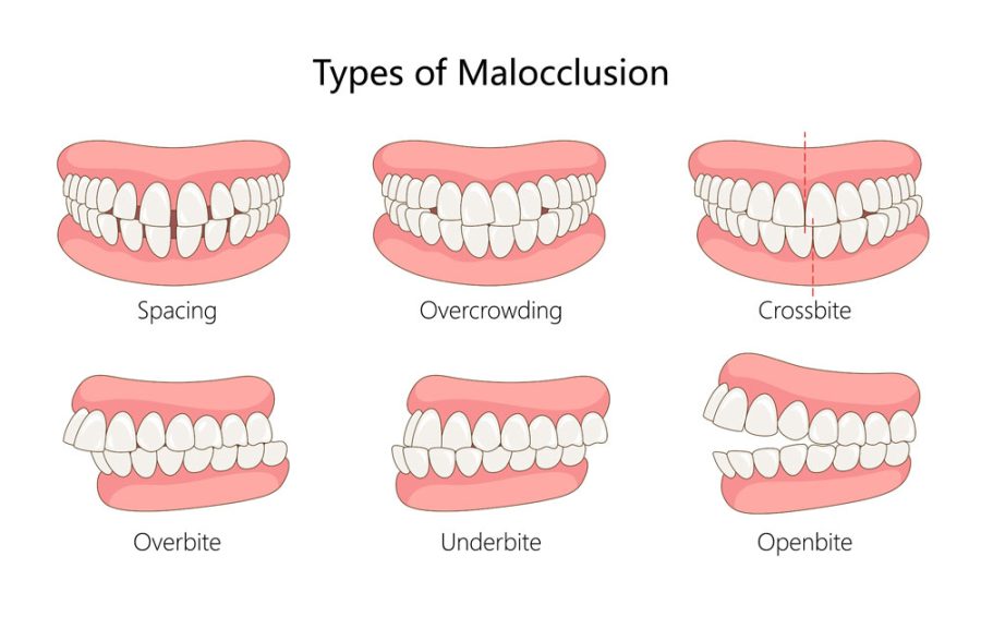Overbite Underbite or Crossbite: What's the Difference and How Are They Fixed